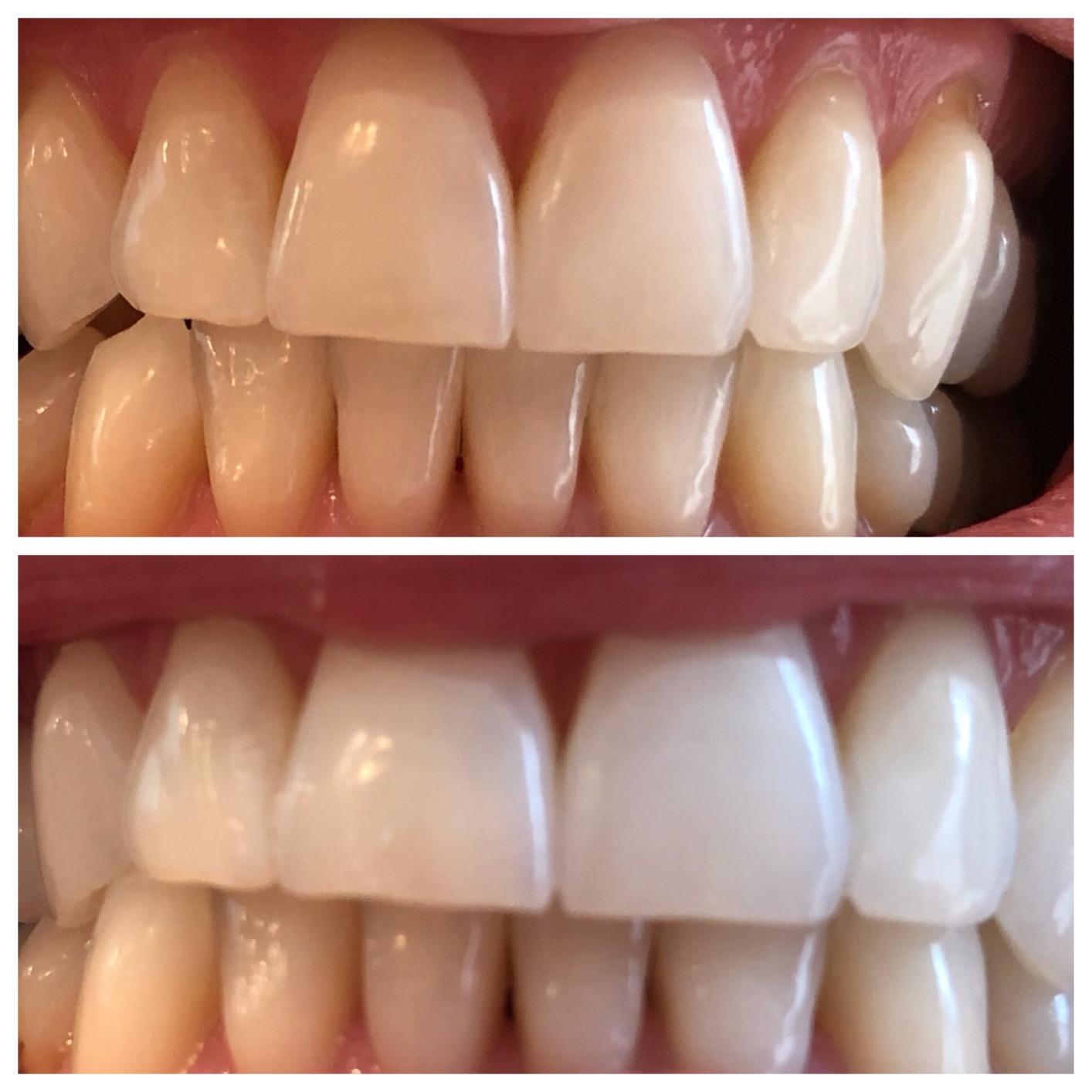 Teeth Whitening- Polvo Blanqueador de Carbón activado