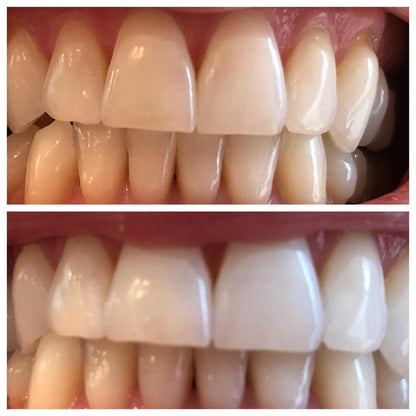 Teeth Whitening- Polvo Blanqueador de Carbón activado